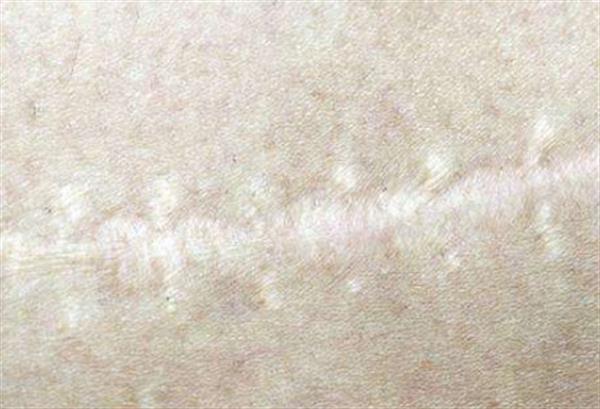 開刀后疤痕消除術有哪些