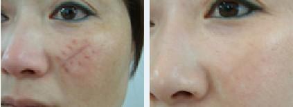 激光去疤后的注意事項(xiàng)