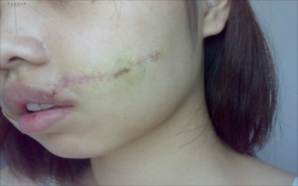 開刀后疤痕怎么消除