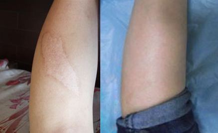 一般刀疤可以去除嗎