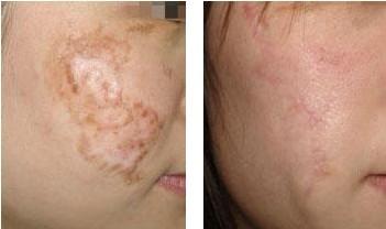 激光<a href=http://m.f3bb6.cn/listinfo-783-0.html target=_blank class=infotextkey>祛疤</a>到底有效果嗎