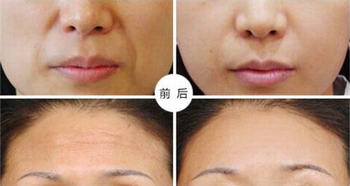 自體脂肪豐面頰多少錢