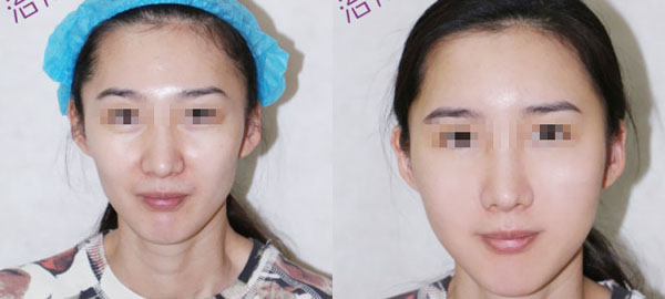 <a href=http://m.f3bb6.cn/listinfo-690-0.html target=_blank class=infotextkey>自體脂肪填充</a>面頰好嗎