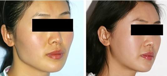 方臉較可能瘦成什么臉