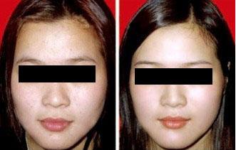 復合彩光<a href=http://m.f3bb6.cn/listinfo-795-0.html target=_blank class=infotextkey>祛斑</a>效果好嗎