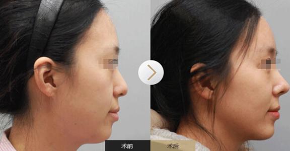 透明質(zhì)酸的<a href=http://m.f3bb6.cn/listinfo-737-0.html target=_blank class=infotextkey>隆鼻</a>效果是否自然