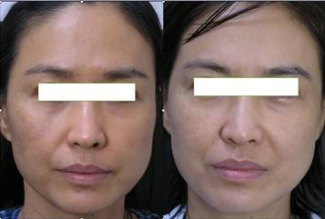 e光<a href=http://m.f3bb6.cn/listinfo-795-0.html target=_blank class=infotextkey>祛斑</a>有副作用嗎 