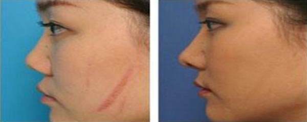 臉上疤痕怎么消除