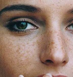 黃褐斑怎么形成的