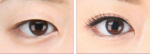 開內眼角手術后還會回縮嗎