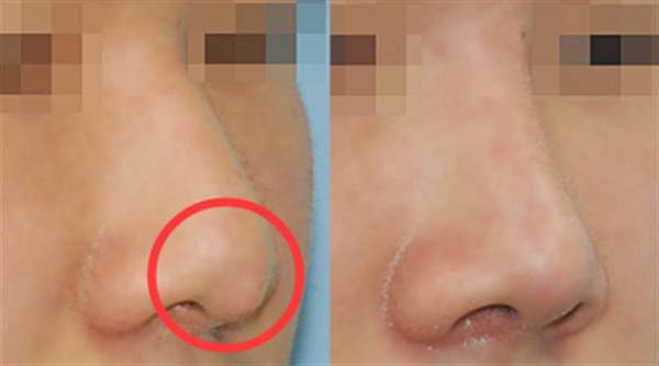 假體取出后會(huì)增生怎么辦