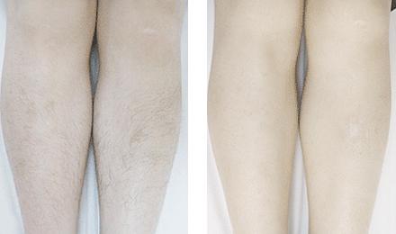 <a href=http://m.f3bb6.cn/listinfo-670-0.html target=_blank class=infotextkey>脫毛</a>的常用方法有哪些