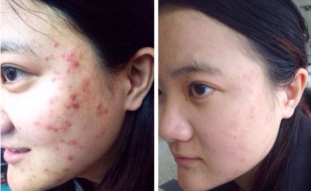 長痘痘了怎么辦