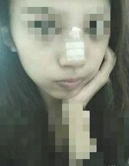 鼻子墊完假體第3天照片