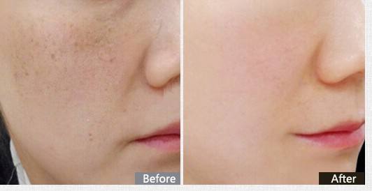 怎么快速去黃去斑