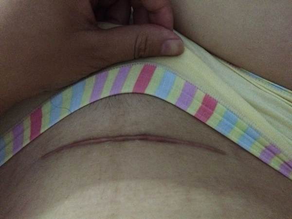  術(shù)后多久是疤痕增生期