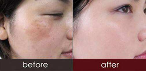 皮膚美白去斑效果怎么樣