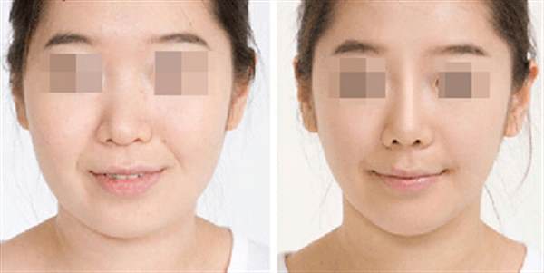 鼻孔縮小的方法有哪些