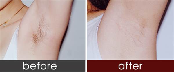 激光<a href=http://m.f3bb6.cn/listinfo-670-0.html target=_blank class=infotextkey>脫毛</a>真的長期嗎