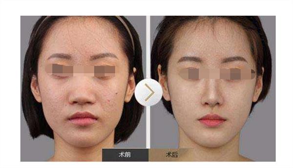 <a href=http://m.f3bb6.cn/listinfo-754-0.html target=_blank class=infotextkey>鼻翼</a>縮小術(shù)后護(hù)理措施有哪些