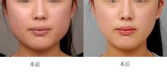 打<a href=http://m.f3bb6.cn/listinfo-631-0.html target=_blank class=infotextkey>瘦臉</a><a href=http://m.f3bb6.cn/listinfo-614-0.html target=_blank class=infotextkey>除皺</a>大概多少錢