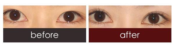 <a href=http://m.f3bb6.cn/listinfo-724-0.html target=_blank class=infotextkey>雙眼皮</a>埋線怎樣散瘀血