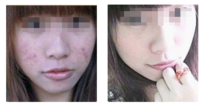 祛痘手術的費用