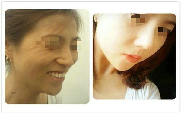 做透明質酸<a href=http://m.f3bb6.cn/listinfo-737-0.html target=_blank class=infotextkey>隆鼻</a>注意事項？