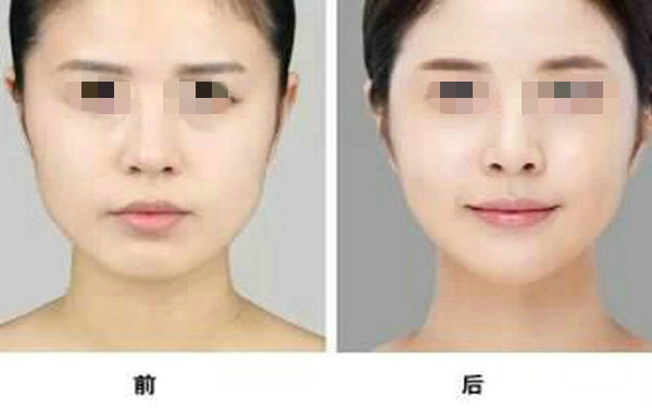 注射<a href=http://m.f3bb6.cn/listinfo-737-0.html target=_blank class=infotextkey>隆鼻</a>有什么壞處？