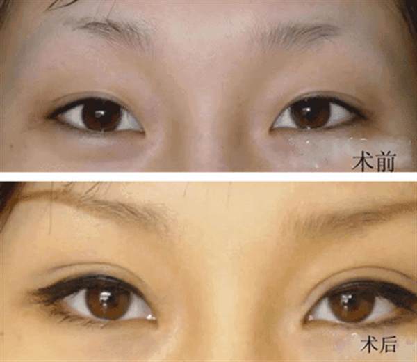 <a href=http://m.f3bb6.cn/listinfo-711-0.html target=_blank class=infotextkey>開眼角</a>疼嗎