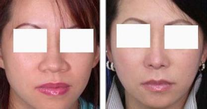 <a href=http://m.f3bb6.cn/listinfo-754-0.html target=_blank class=infotextkey>鼻翼</a>縮小手術價格主要與哪些因素有關