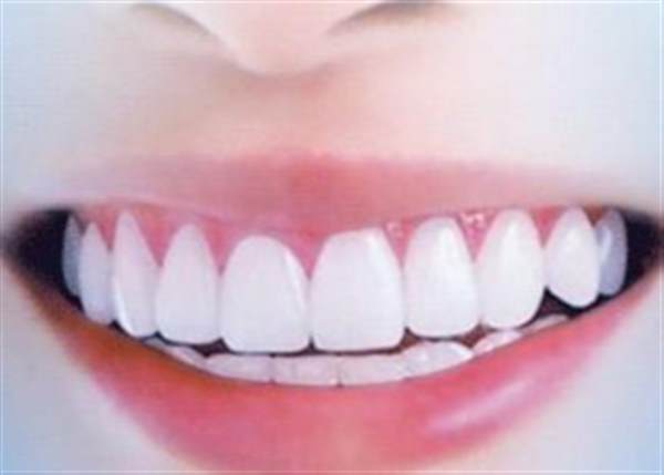 超聲波洗牙術后注意事項