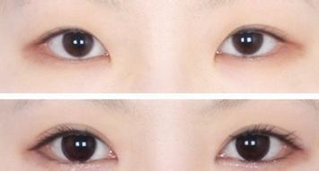 <a href=http://m.f3bb6.cn/listinfo-711-0.html target=_blank class=infotextkey>開眼角</a>失敗修復怎么做