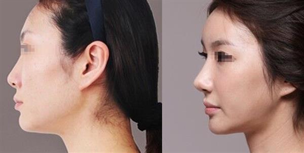 透明質酸注射<a href=http://m.f3bb6.cn/listinfo-737-0.html target=_blank class=infotextkey>隆鼻</a>的效果維持多久