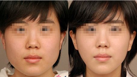 <a href=http://m.f3bb6.cn/listinfo-631-0.html target=_blank class=infotextkey>瘦臉</a><a href=http://m.f3bb6.cn/listinfo-614-0.html target=_blank class=infotextkey>除皺</a>正規醫院多少錢