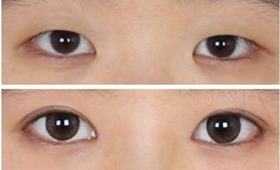 <a href=http://m.f3bb6.cn/listinfo-711-0.html target=_blank class=infotextkey>開眼角</a>恢復(fù)期是多久