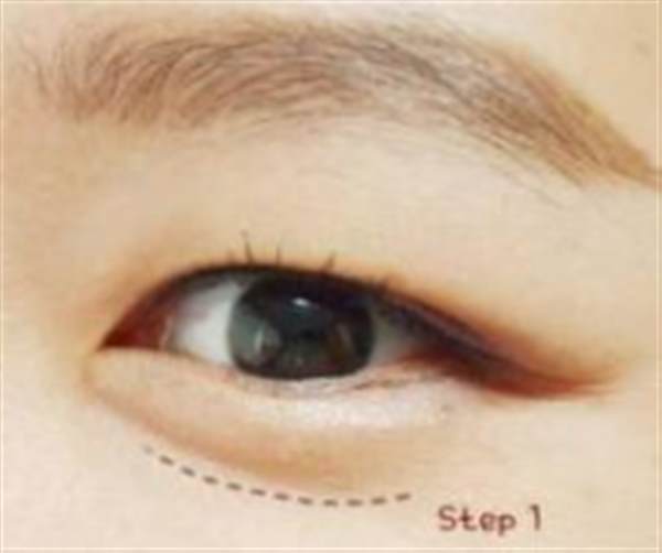 透明質酸注射<a href=http://m.f3bb6.cn/listinfo-722-0.html target=_blank class=infotextkey>臥蠶</a>多少錢