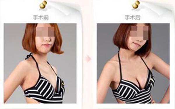 妙桃假體<a href=http://m.f3bb6.cn/listinfo-618-0.html target=_blank class=infotextkey>隆胸</a>術后須知