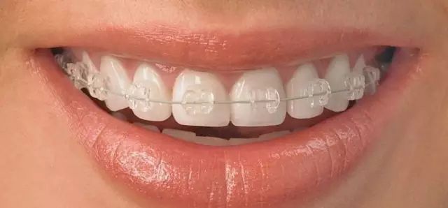 半隱形矯正價格