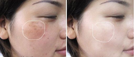 開塞露配什么可以<a href=http://m.f3bb6.cn/listinfo-795-0.html target=_blank class=infotextkey>祛斑</a>