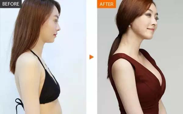 妙桃假體<a href=http://m.f3bb6.cn/listinfo-618-0.html target=_blank class=infotextkey>隆胸</a>的效果與優(yōu)勢