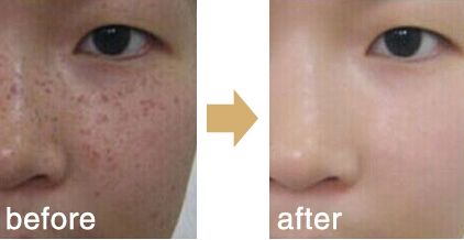 激光去斑后注意事項(xiàng)