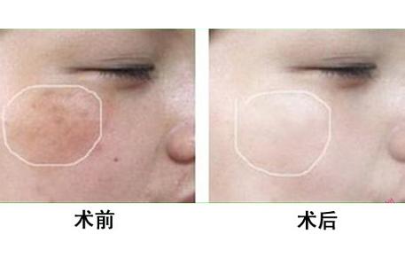 怎樣<a href=http://m.f3bb6.cn/listinfo-795-0.html target=_blank class=infotextkey>祛斑</a>有效