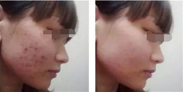 日常生活中有哪些去痘痘的小妙招