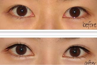 有黑眼圈怎么去