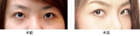 開外眼角前后對比照