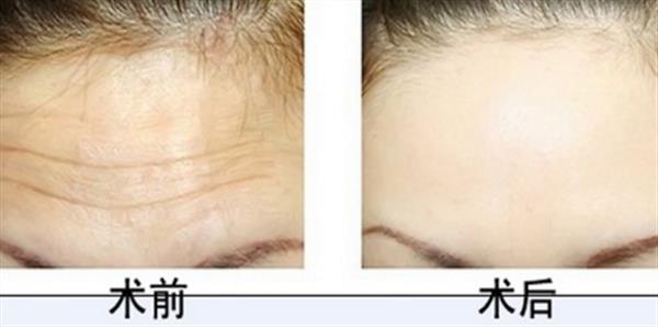 16歲有抬頭紋怎么解決