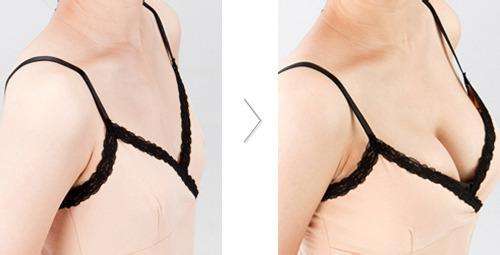 假體<a href=http://m.f3bb6.cn/listinfo-618-0.html target=_blank class=infotextkey>隆胸</a>多少錢