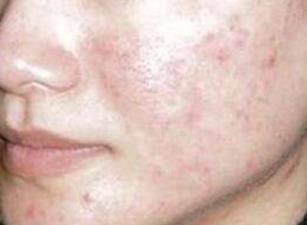 激光祛痘手術效果好嗎