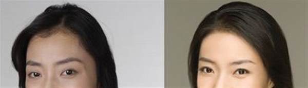 做發際線前后對比照